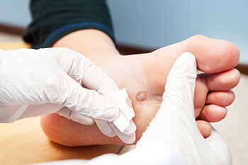 Warts treatment in the Kokomo, IN 46902 area
