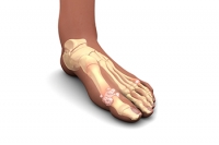 Joint Pain in the Feet May Indicate One or More Type of Arthritis