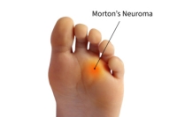 Navigating the Discomfort of Morton’s Neuroma