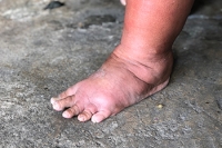 The Many Causes of Swollen Feet