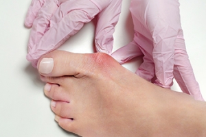 What Is Hallux Rigidus?