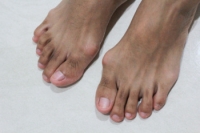 Dealing With Bunions