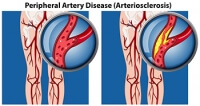 What Are the Symptoms of PAD?