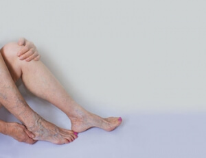 What Causes Varicose Veins?