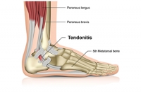 Causes of Achilles Tendon Injuries