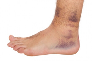 Chronic Ankle Instability