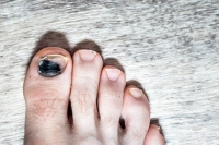 Causes of Black Toenail